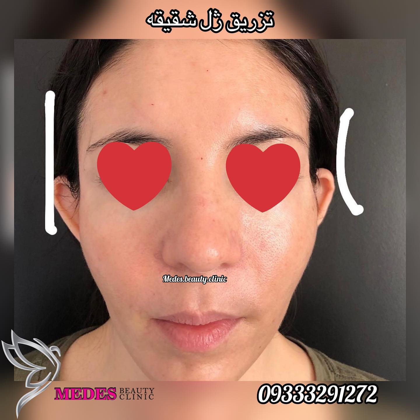 گالری زاویه سازی صورت